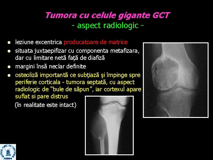 Tumora cu celule gigante GCT - aspect radiologic - l l leziune excentrica producatoare