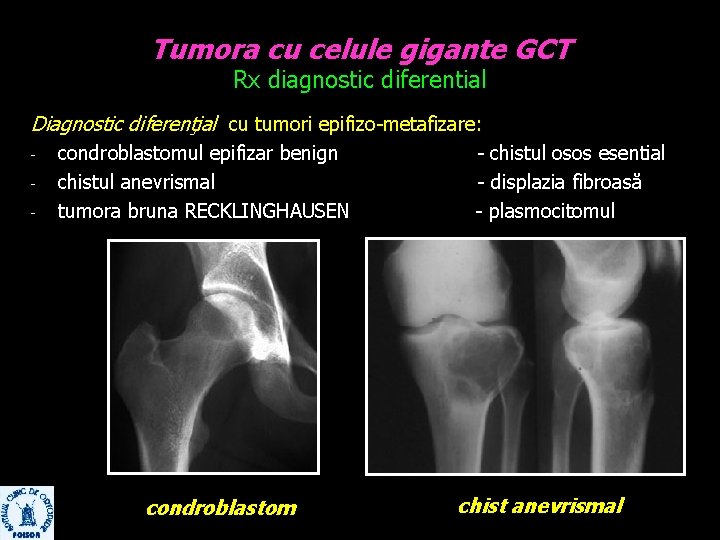 Tumora cu celule gigante GCT Rx diagnostic diferential Diagnostic diferenţial cu tumori epifizo-metafizare: -