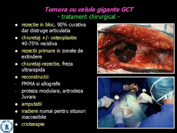 Tumora cu celule gigante GCT - tratament chirurgical - l l l l rezectie