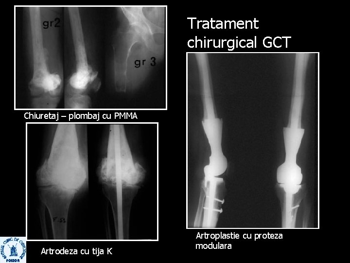 Tratament chirurgical GCT Chiuretaj – plombaj cu PMMA Artrodeza cu tija K Artroplastie cu