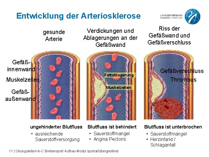 Entwicklung der Arteriosklerose gesunde Arterie Verdickungen und Ablagerungen an der Gefäßwand Gefäßinnenwand Muskelzellen Gefäßaußenwand