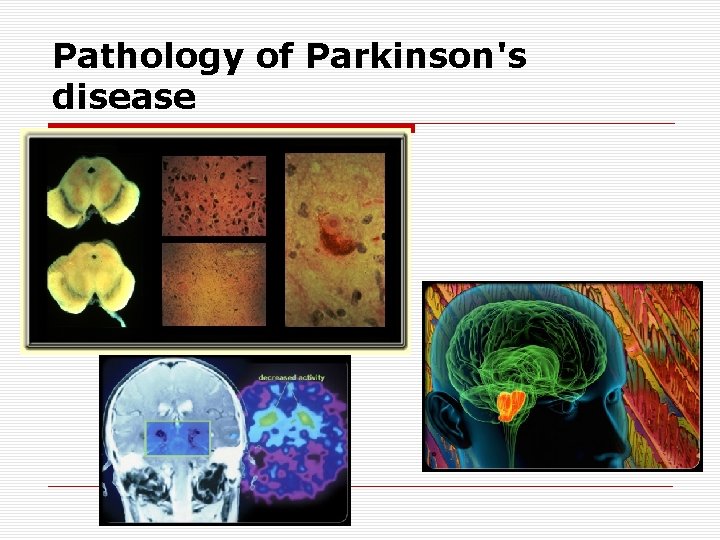 Pathology of Parkinson's disease 