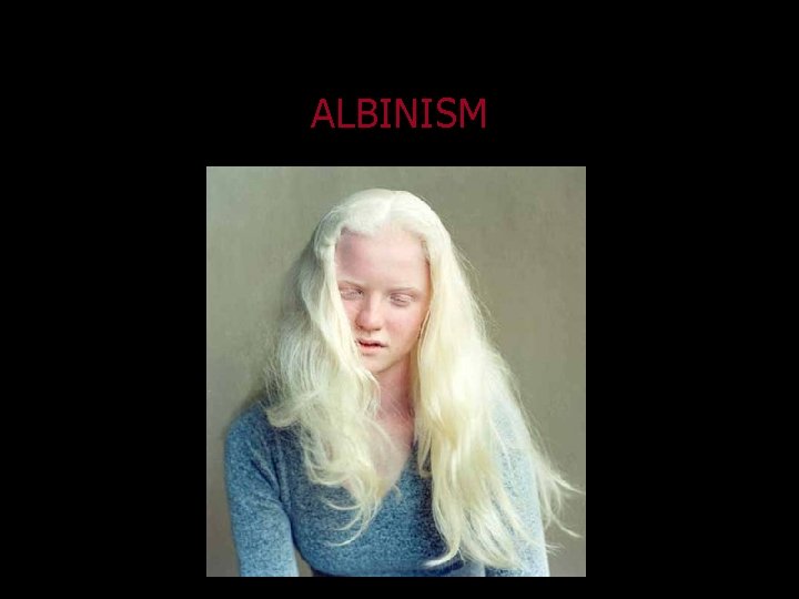 ALBINISM 