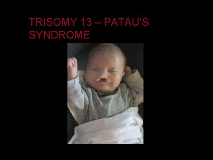 TRISOMY 13 – PATAU’S SYNDROME 