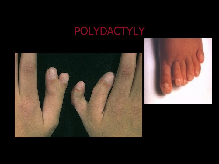 POLYDACTYLY 