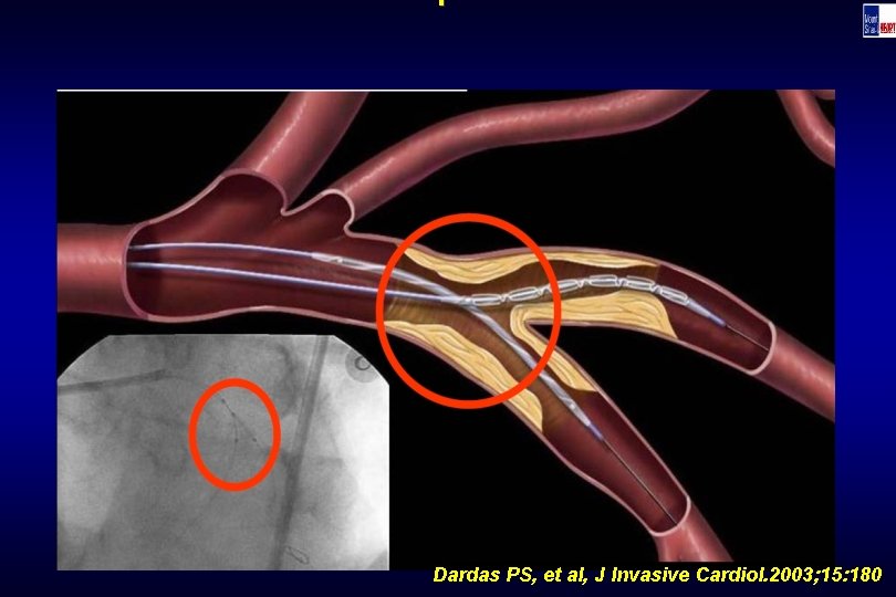 Technique Dardas PS, et al, J Invasive Cardiol. 2003; 15: 180 