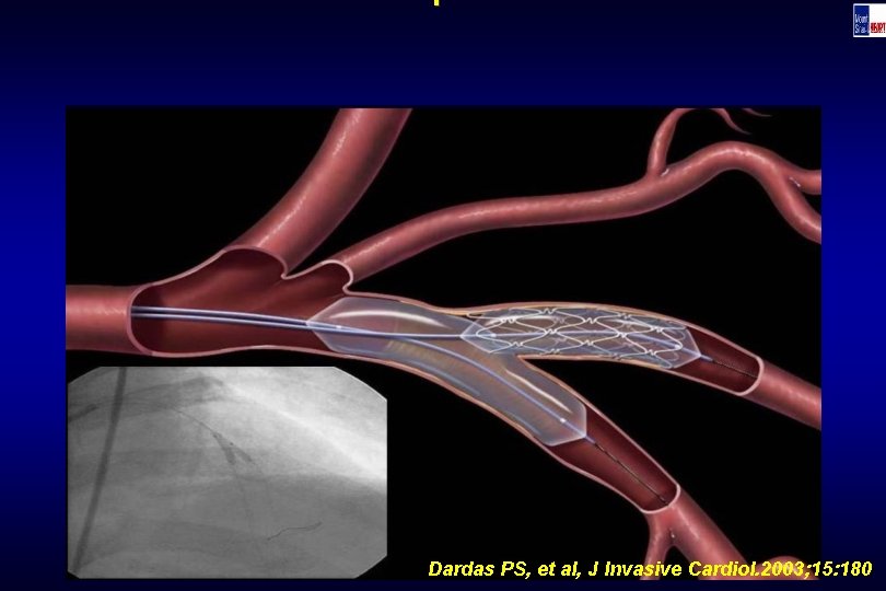 Technique Dardas PS, et al, J Invasive Cardiol. 2003; 15: 180 