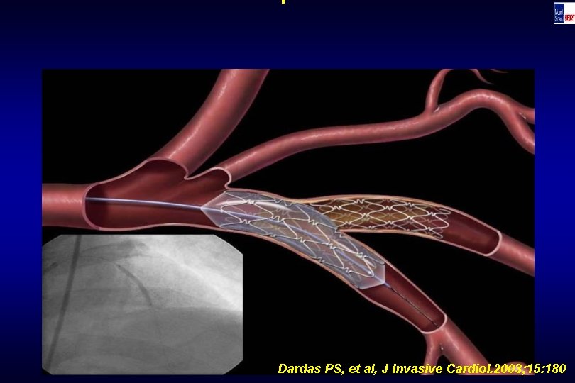 Technique Dardas PS, et al, J Invasive Cardiol. 2003; 15: 180 