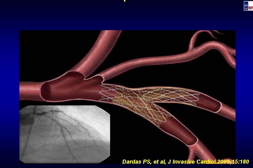Technique Dardas PS, et al, J Invasive Cardiol. 2003; 15: 180 