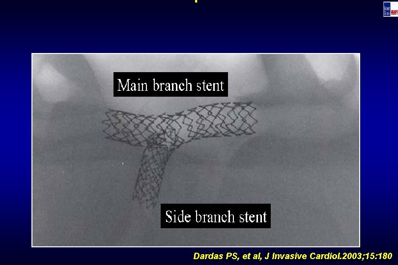 Technique Dardas PS, et al, J Invasive Cardiol. 2003; 15: 180 