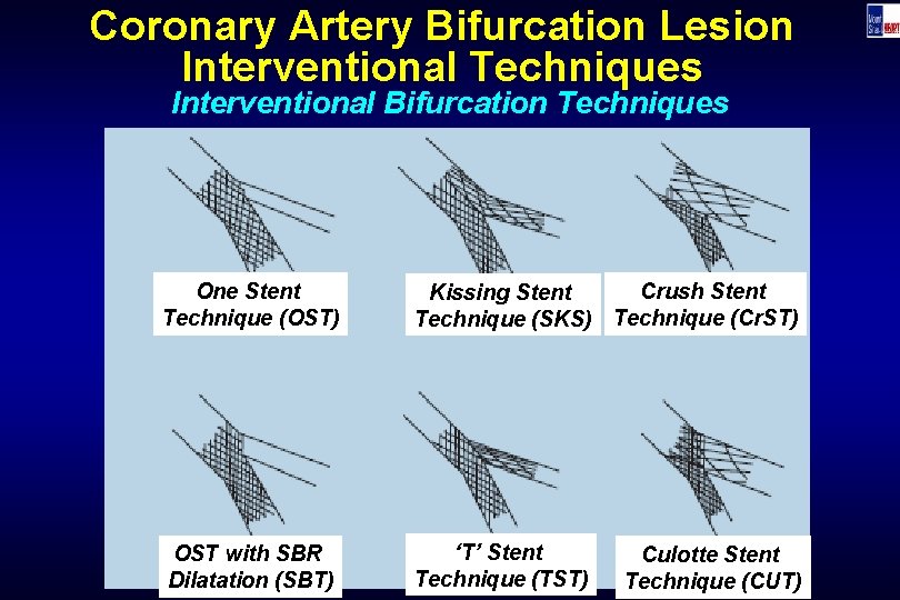 Coronary Artery Bifurcation Lesion Interventional Techniques Interventional Bifurcation Techniques One Stent Technique (OST) Crush