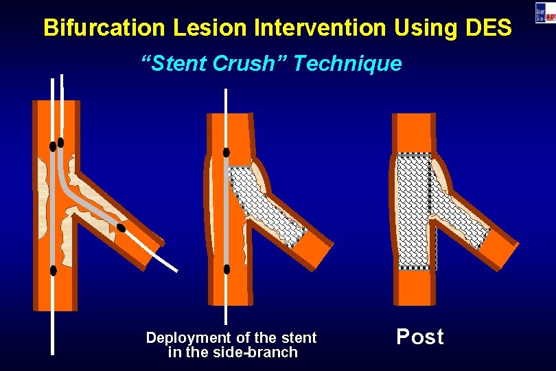 Bifurcation Lesion Intervention Using DES “Stent Crush” Technique Deployment of the stent in the