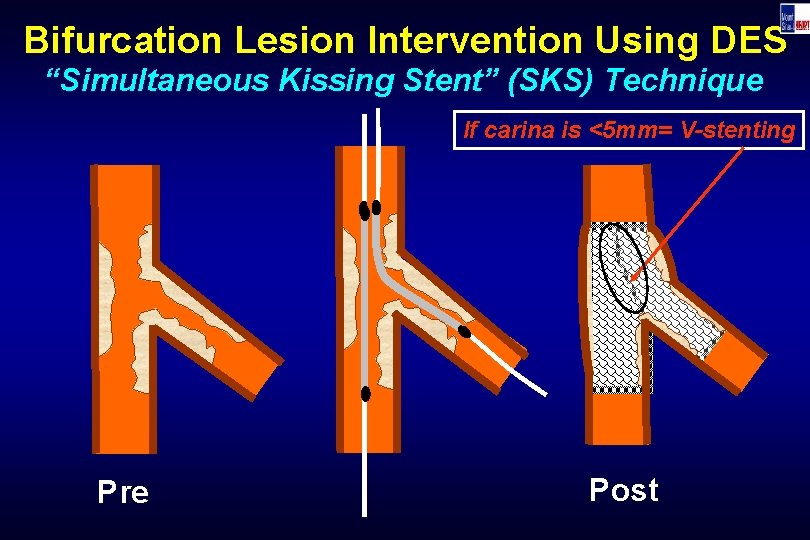 Bifurcation Lesion Intervention Using DES “Simultaneous Kissing Stent” (SKS) Technique If carina is <5