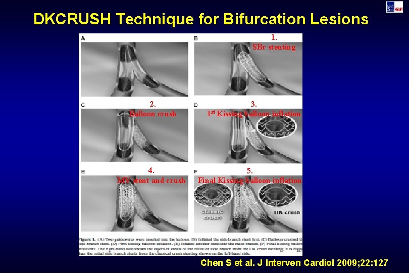 DKCRUSH Technique for Bifurcation Lesions 1. SBr stenting 2. Balloon crush 4. MV stent