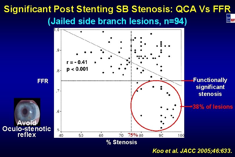 Significant Post Stenting SB Stenosis: QCA Vs FFR (Jailed side branch lesions, n=94) Functionally