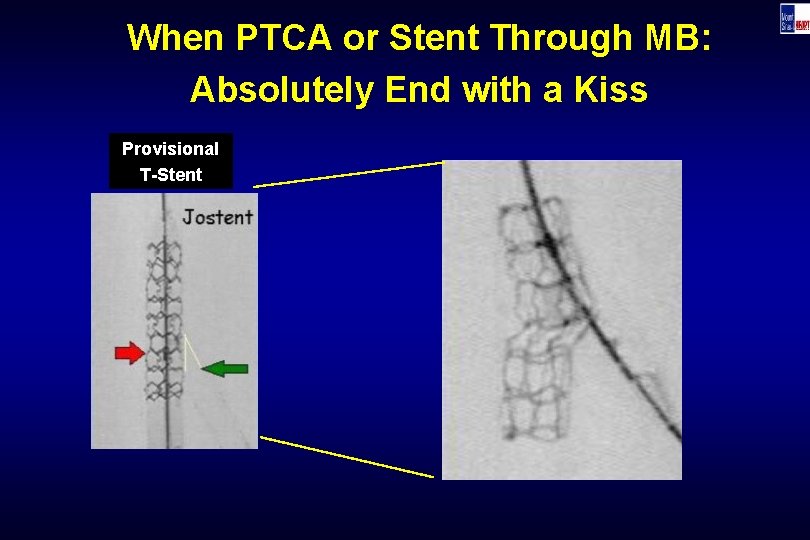 When PTCA or Stent Through MB: Absolutely End with a Kiss Provisional T-Stent 