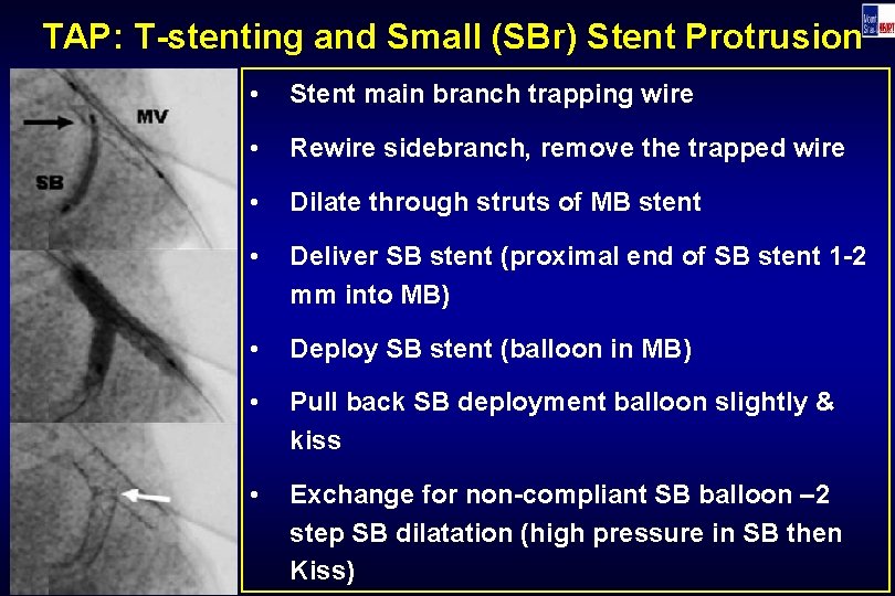 TAP: T-stenting and Small (SBr) Stent Protrusion • Stent main branch trapping wire •