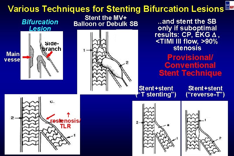 Various Techniques for Stenting Bifurcation Lesions Stent the MV+ Balloon or Debulk SB Bifurcation