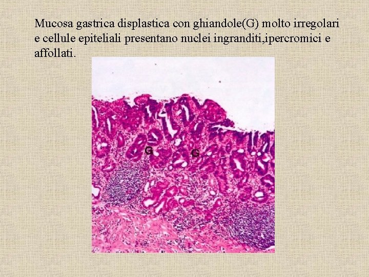 Mucosa gastrica displastica con ghiandole(G) molto irregolari e cellule epiteliali presentano nuclei ingranditi, ipercromici