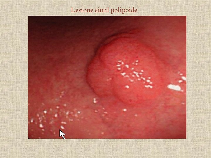 Lesione simil polipoide 