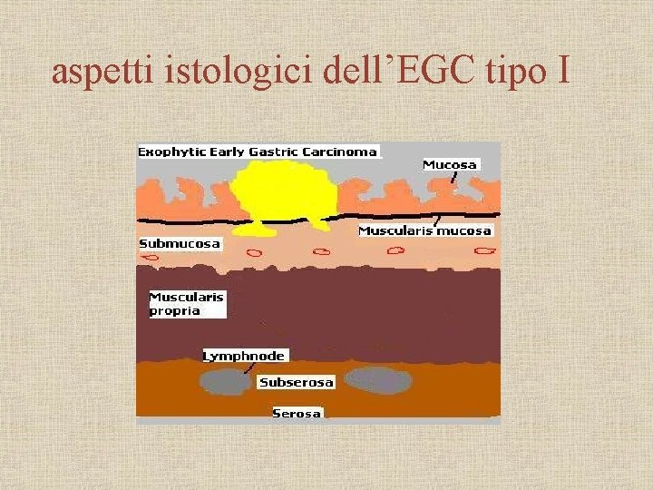 aspetti istologici dell’EGC tipo I 