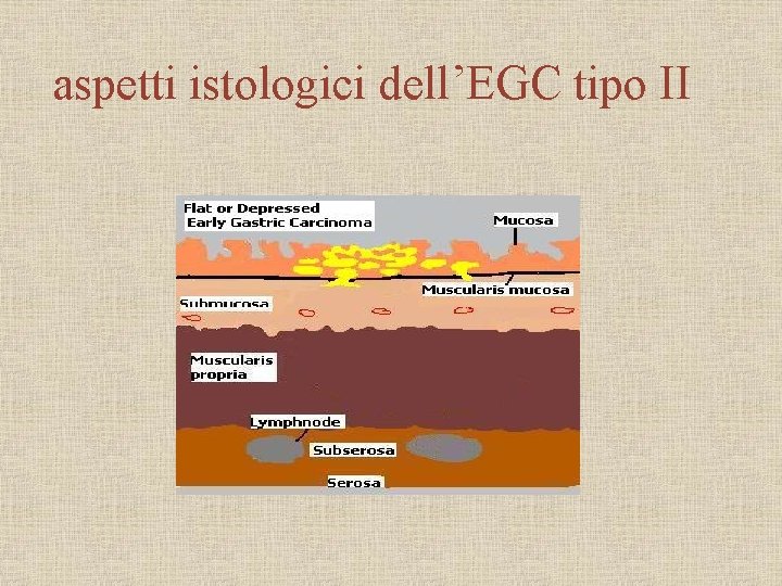 aspetti istologici dell’EGC tipo II 