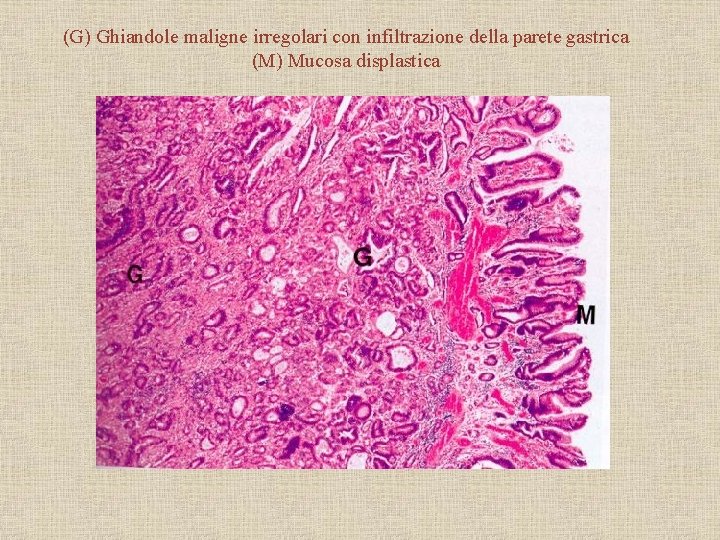 (G) Ghiandole maligne irregolari con infiltrazione della parete gastrica (M) Mucosa displastica 