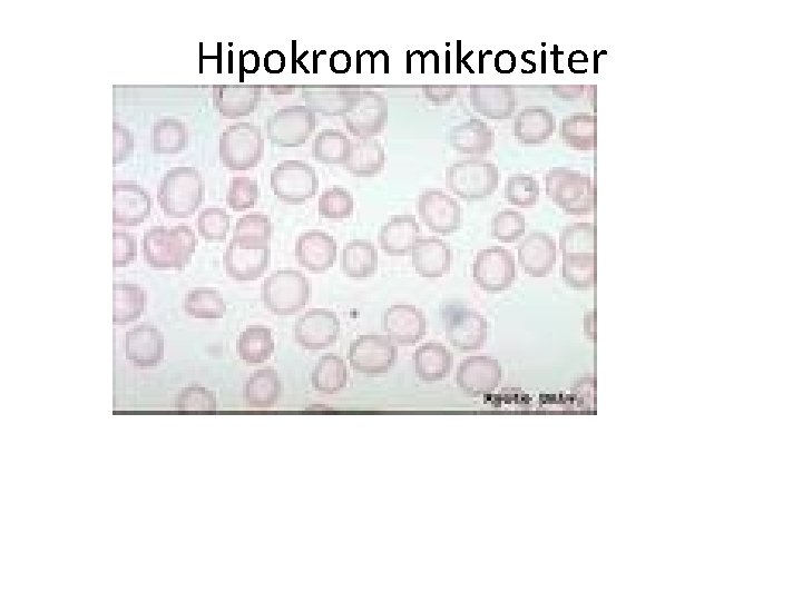 Hipokrom mikrositer 
