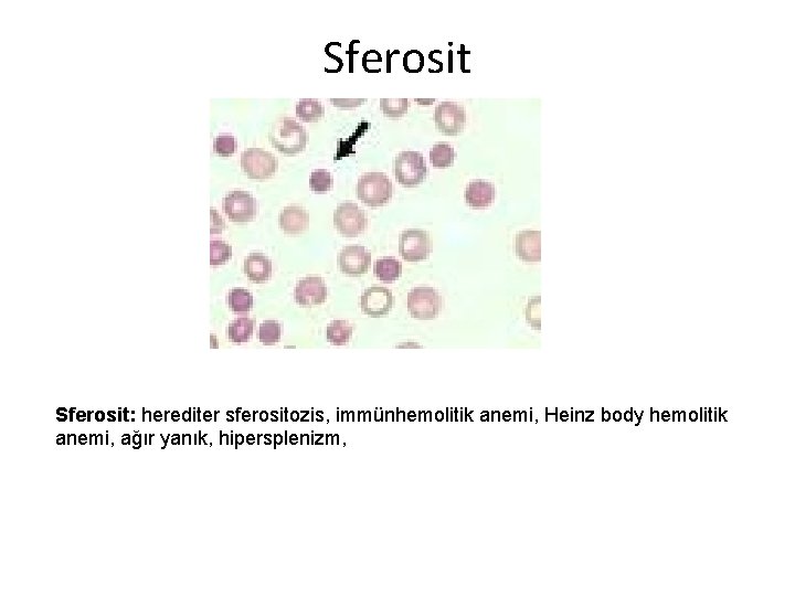 Sferosit: herediter sferositozis, immünhemolitik anemi, Heinz body hemolitik anemi, ağır yanık, hipersplenizm, 