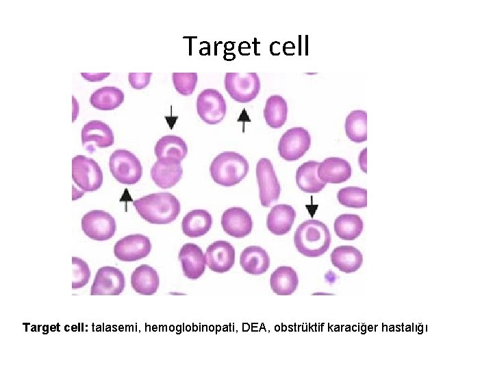 Target cell: talasemi, hemoglobinopati, DEA, obstrüktif karaciğer hastalığı 