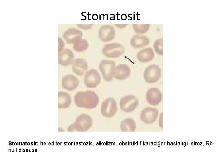 Stomatosit: herediter stomastozis, alkolizm, obstrüktif karaciğer hastalığı, siroz, Rhnull disease 