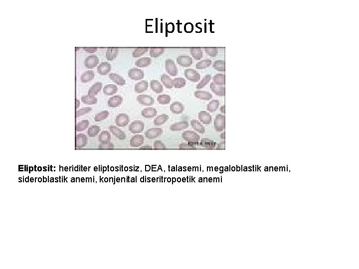 Eliptosit: heriditer eliptosiz, DEA, talasemi, megaloblastik anemi, sideroblastik anemi, konjenital diseritropoetik anemi 
