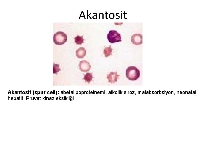 Akantosit (spur cell): abetalipoproteinemi, alkolik siroz, malabsorbsiyon, neonatal hepatit, Pruvat kinaz eksikliği 