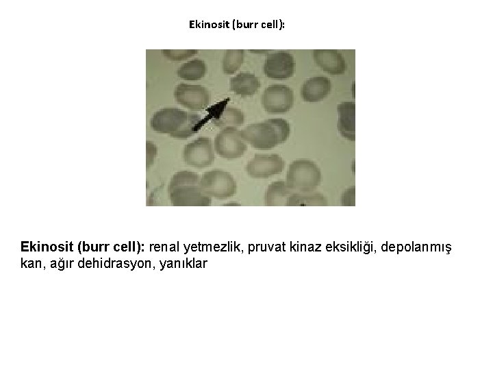 Ekinosit (burr cell): renal yetmezlik, pruvat kinaz eksikliği, depolanmış kan, ağır dehidrasyon, yanıklar 