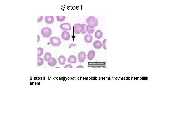 Şistosit: Mikroanjiyopatik hemolitik anemi, travmatik hemoliitk anemi 