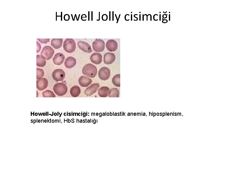 Howell Jolly cisimciği Howell-Joly cisimciği: megaloblastik anemia, hiposplenism, splenektomi, Hb. S hastalığı 