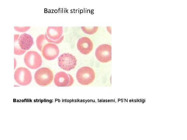 Bazofilik stripling: Pb intopksikasyonu, talasemi, P 5’N eksikliği 