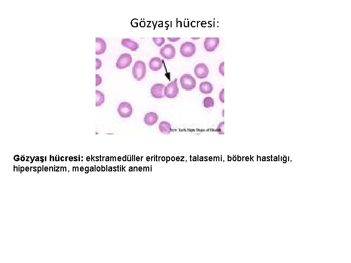 Gözyaşı hücresi: ekstramedüller eritropoez, talasemi, böbrek hastalığı, hipersplenizm, megaloblastik anemi 