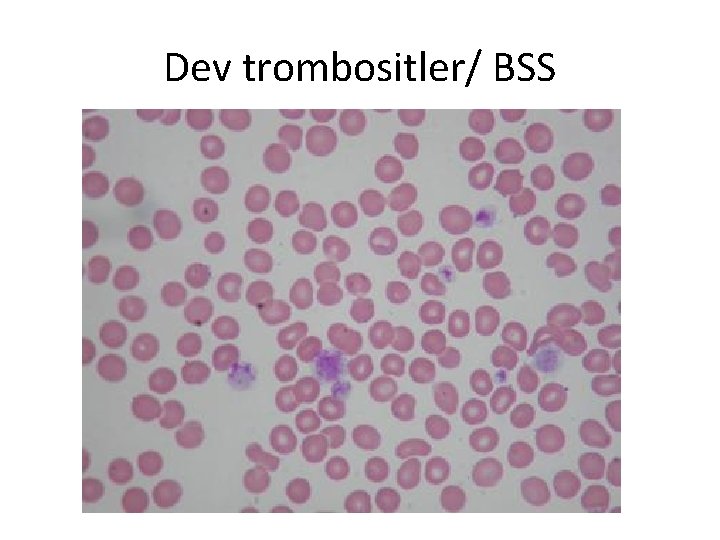 Dev trombositler/ BSS 
