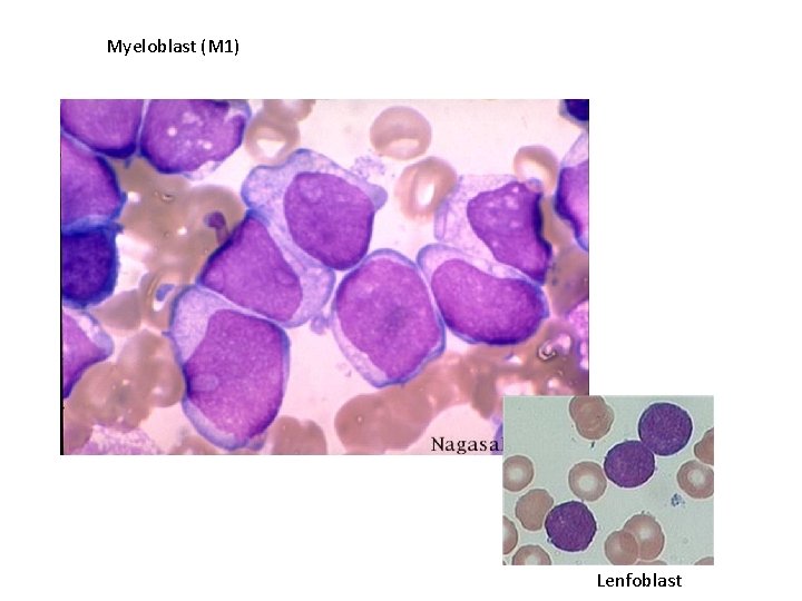 Myeloblast (M 1) Lenfoblast 