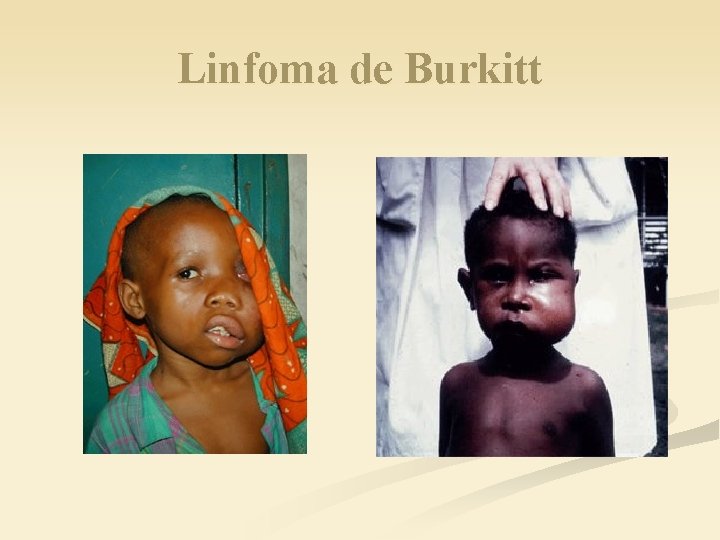 Linfoma de Burkitt 