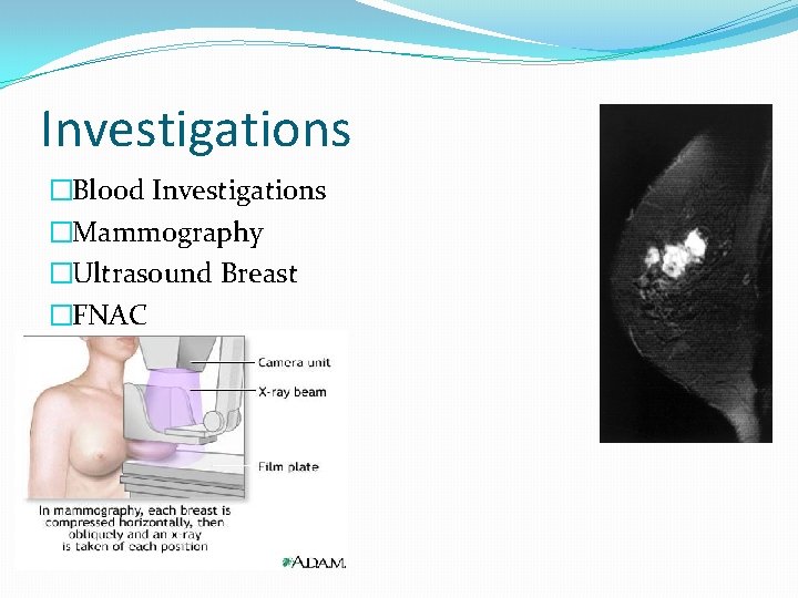 Investigations �Blood Investigations �Mammography �Ultrasound Breast �FNAC 