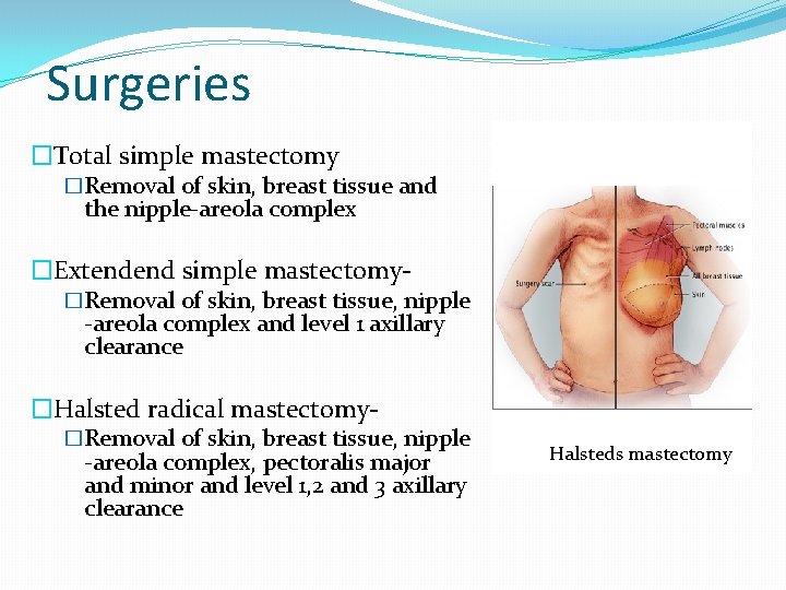 Surgeries �Total simple mastectomy �Removal of skin, breast tissue and the nipple-areola complex �Extendend
