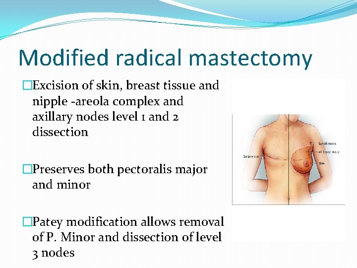 Modified radical mastectomy �Excision of skin, breast tissue and nipple -areola complex and axillary