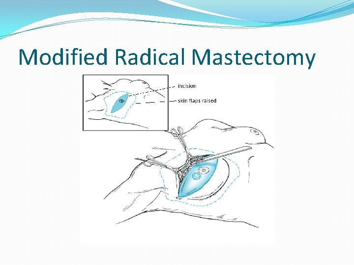 Modified Radical Mastectomy 