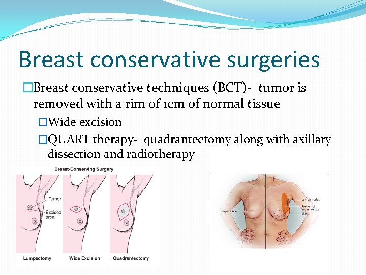 Breast conservative surgeries �Breast conservative techniques (BCT)- tumor is removed with a rim of