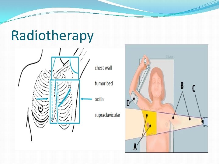 Radiotherapy 