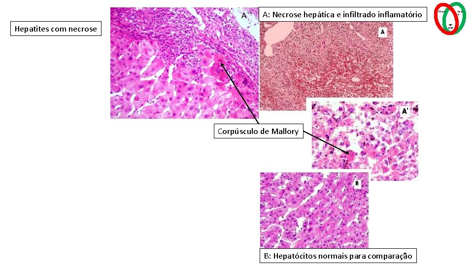 A`` A: Necrose hepática e infiltrado inflamatório Hepatites com necrose Básico Clínic o MSP