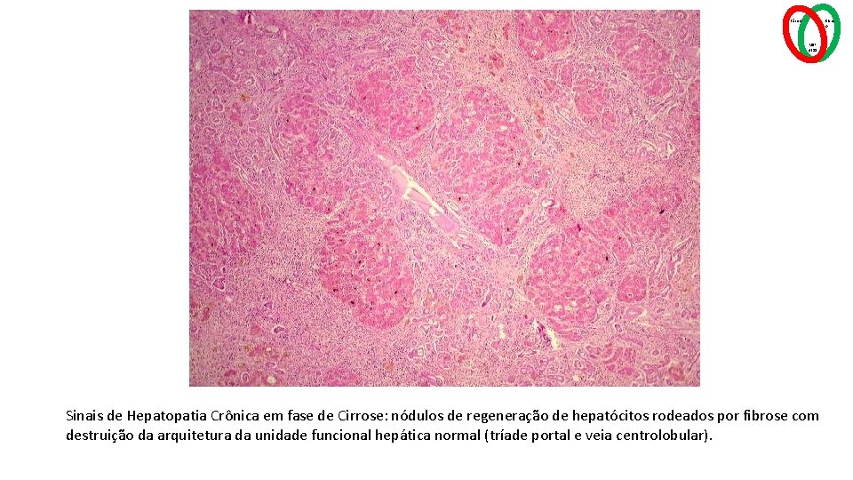 Básico Clínic o MSP 4211 Sinais de Hepatopatia Crônica em fase de Cirrose: nódulos