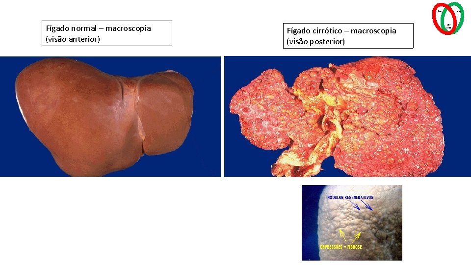 Básico Fígado normal – macroscopia (visão anterior) Fígado cirrótico – macroscopia (visão posterior) Clínic